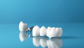 Are Metal Crowns Still Used? When and Why They’re Recommended