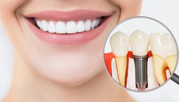 Can Anyone Get Dental Implants? Eligibility Explained