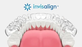 Cleaning of Invisalign Aligners
